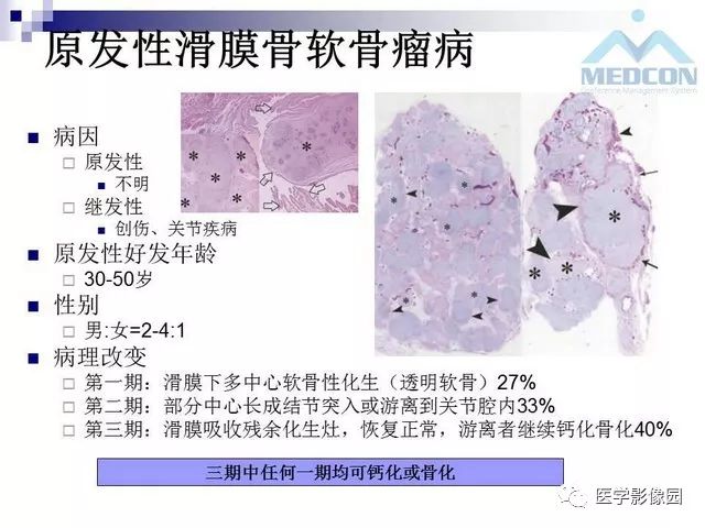 【PPT】关节内肿瘤及肿瘤样病变