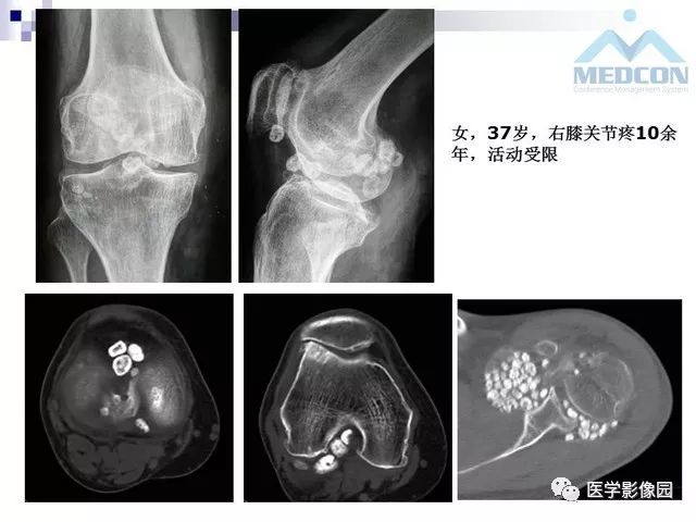 【PPT】关节内肿瘤及肿瘤样病变