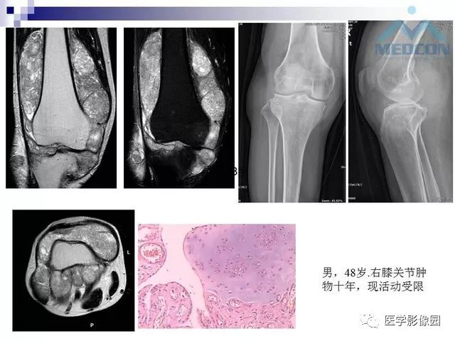 【PPT】关节内肿瘤及肿瘤样病变