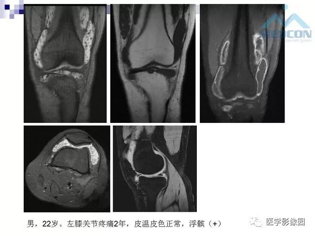 【PPT】关节内肿瘤及肿瘤样病变