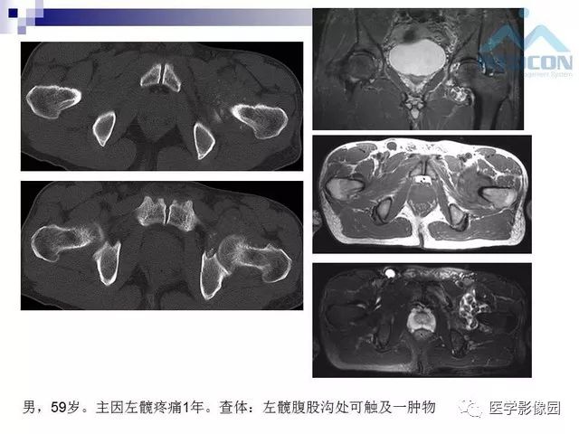 【PPT】关节内肿瘤及肿瘤样病变