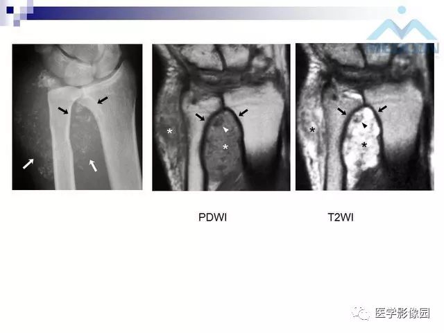 【PPT】关节内肿瘤及肿瘤样病变