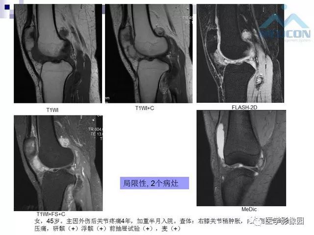 【PPT】关节内肿瘤及肿瘤样病变