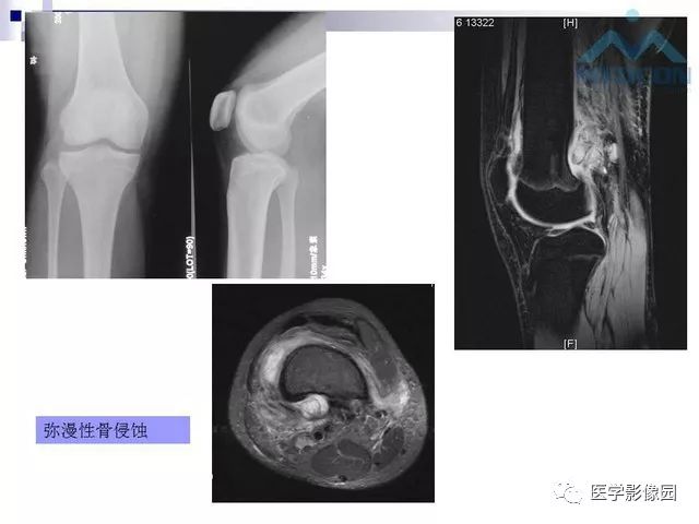 【PPT】关节内肿瘤及肿瘤样病变