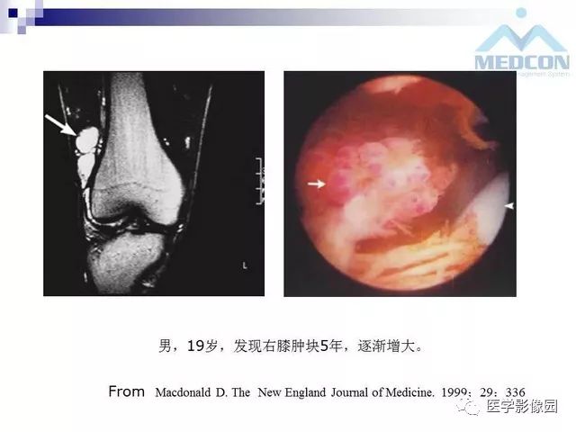【PPT】关节内肿瘤及肿瘤样病变