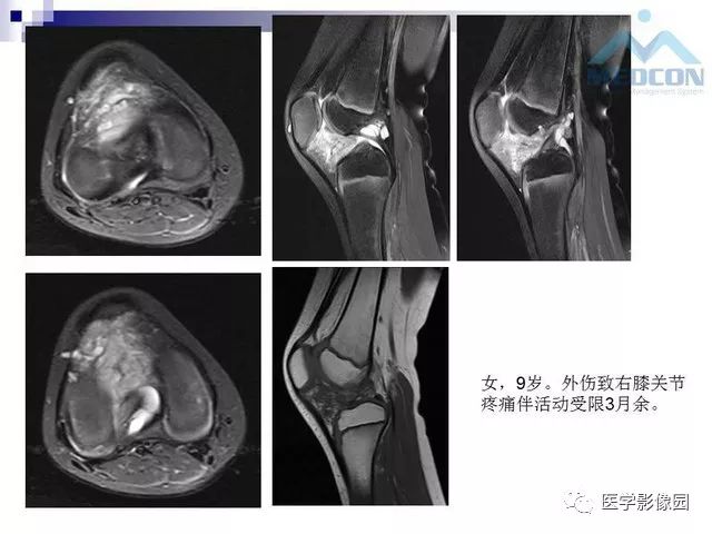 【PPT】关节内肿瘤及肿瘤样病变
