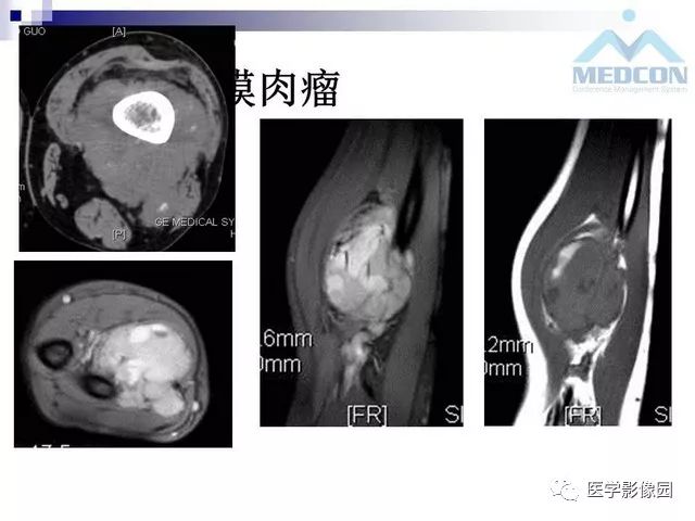 【PPT】关节内肿瘤及肿瘤样病变