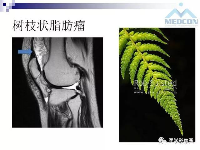 【PPT】关节内肿瘤及肿瘤样病变