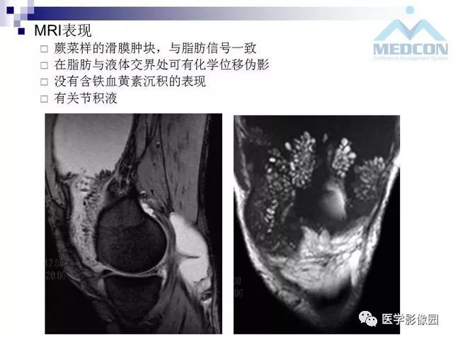 【PPT】关节内肿瘤及肿瘤样病变