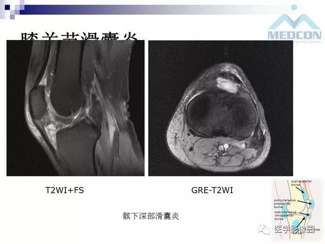 【PPT】关节内肿瘤及肿瘤样病变