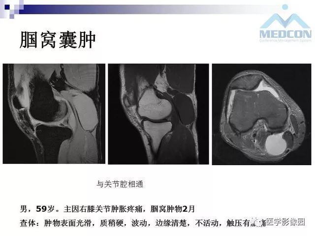 【PPT】关节内肿瘤及肿瘤样病变