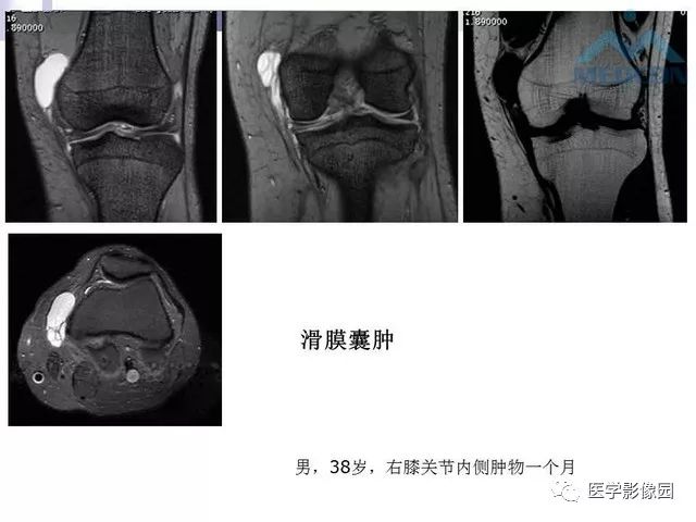 【PPT】关节内肿瘤及肿瘤样病变