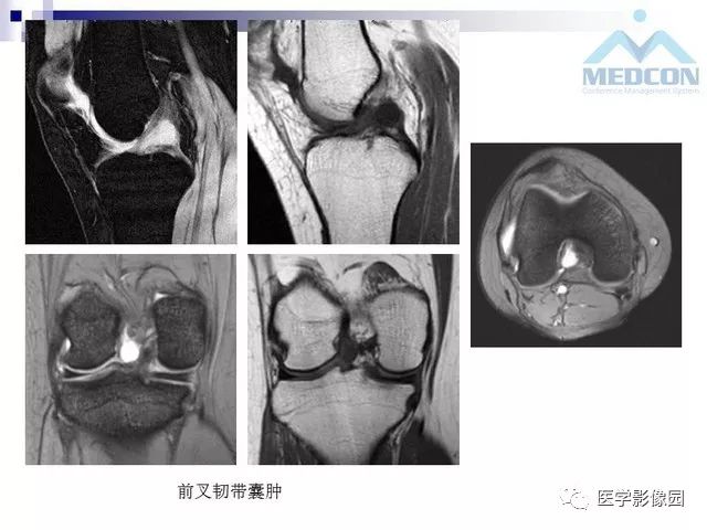 【PPT】关节内肿瘤及肿瘤样病变