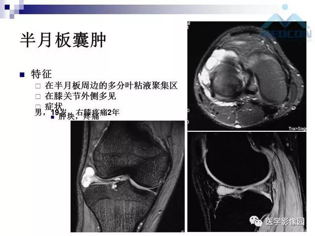 【PPT】关节内肿瘤及肿瘤样病变