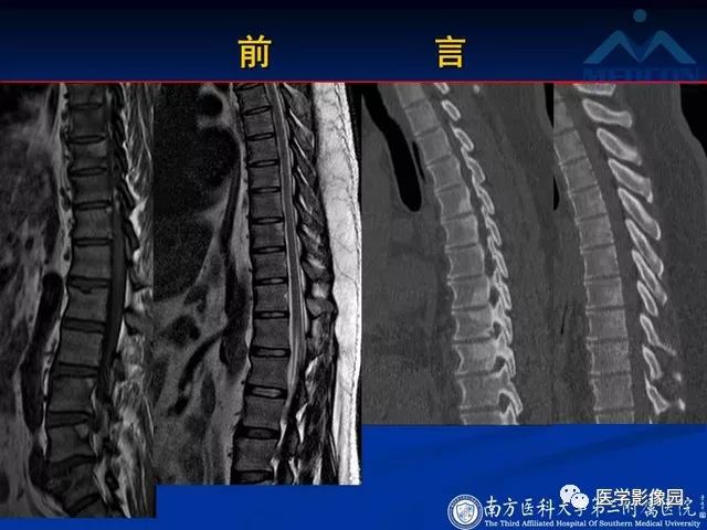 【PPT】系统性疾病脊椎侵犯病理学改变和影像学诊断