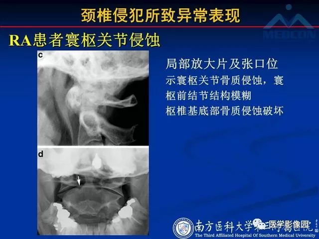 【PPT】系统性疾病脊椎侵犯病理学改变和影像学诊断