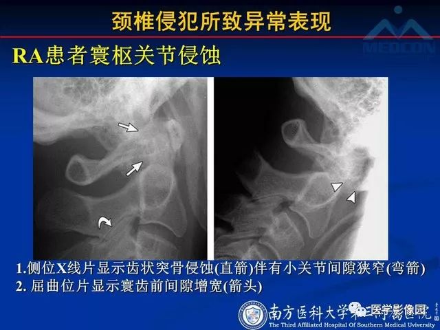【PPT】系统性疾病脊椎侵犯病理学改变和影像学诊断