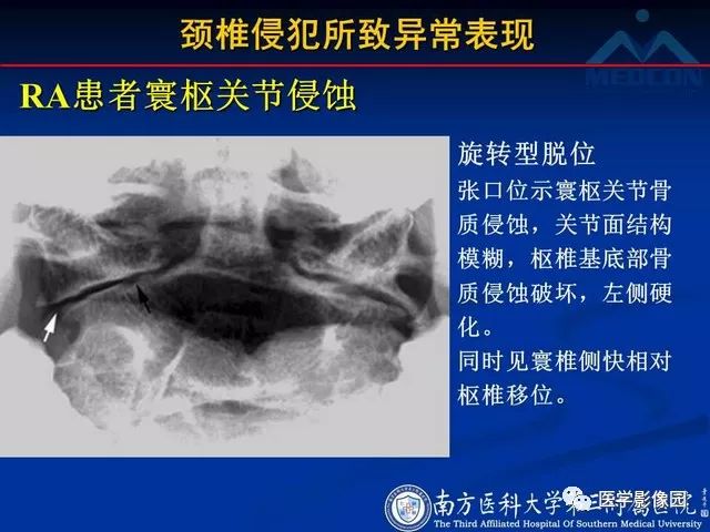 【PPT】系统性疾病脊椎侵犯病理学改变和影像学诊断
