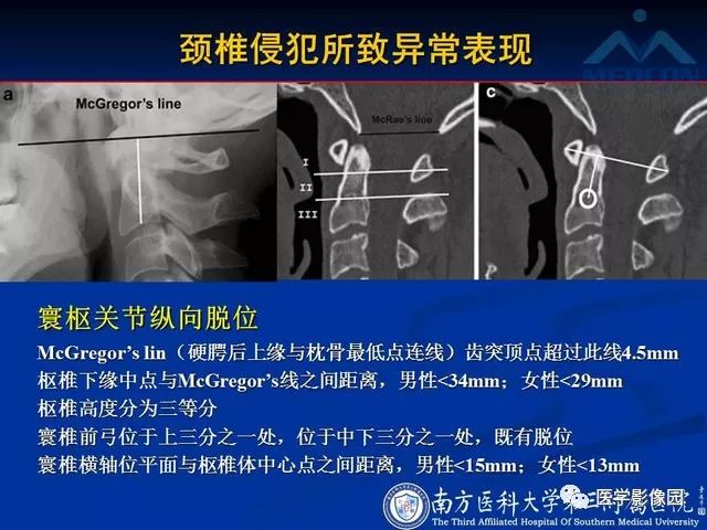 【PPT】系统性疾病脊椎侵犯病理学改变和影像学诊断