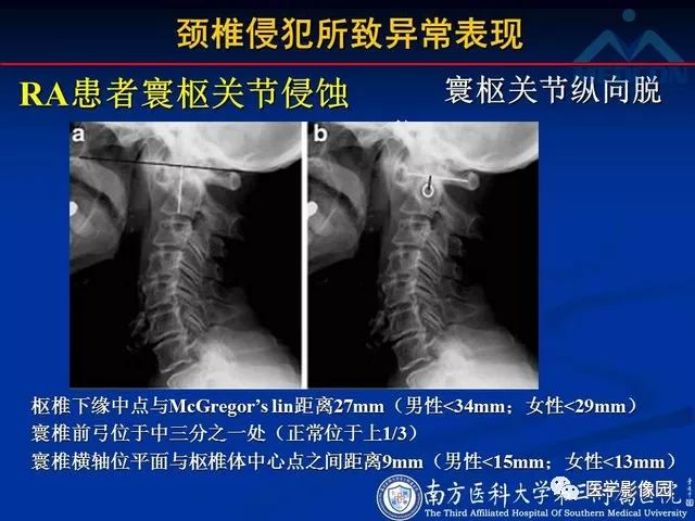 【PPT】系统性疾病脊椎侵犯病理学改变和影像学诊断