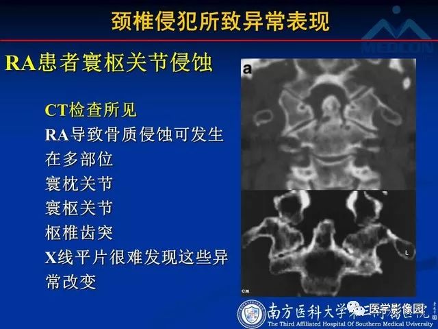 【PPT】系统性疾病脊椎侵犯病理学改变和影像学诊断