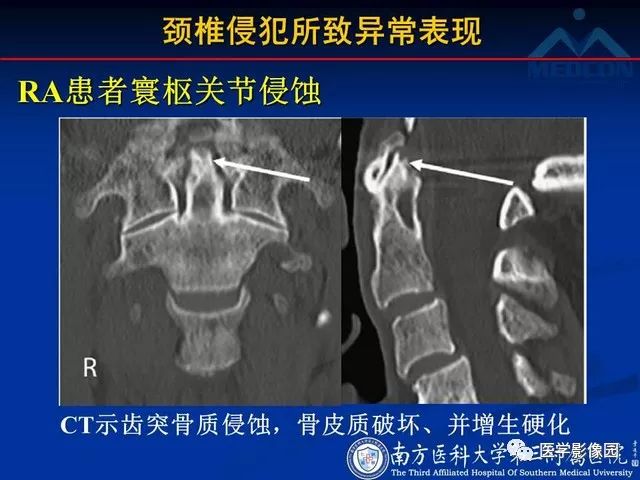 【PPT】系统性疾病脊椎侵犯病理学改变和影像学诊断