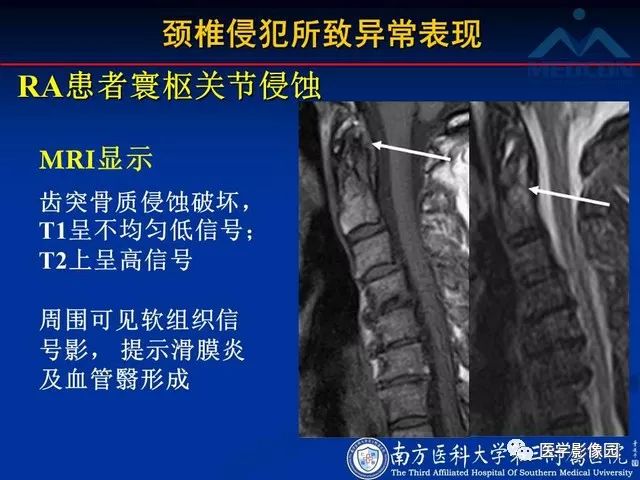【PPT】系统性疾病脊椎侵犯病理学改变和影像学诊断