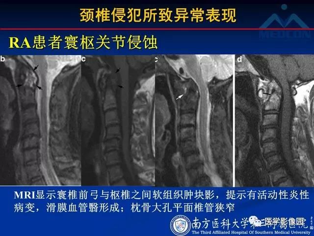 【PPT】系统性疾病脊椎侵犯病理学改变和影像学诊断