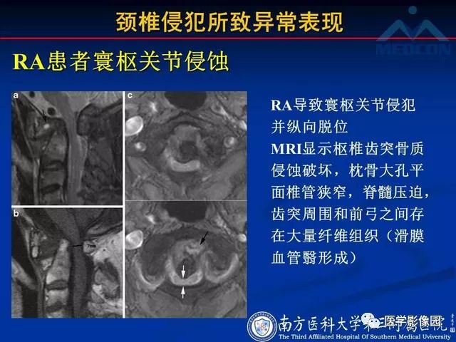 【PPT】系统性疾病脊椎侵犯病理学改变和影像学诊断
