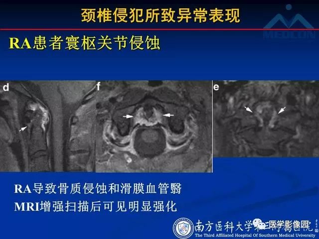 【PPT】系统性疾病脊椎侵犯病理学改变和影像学诊断