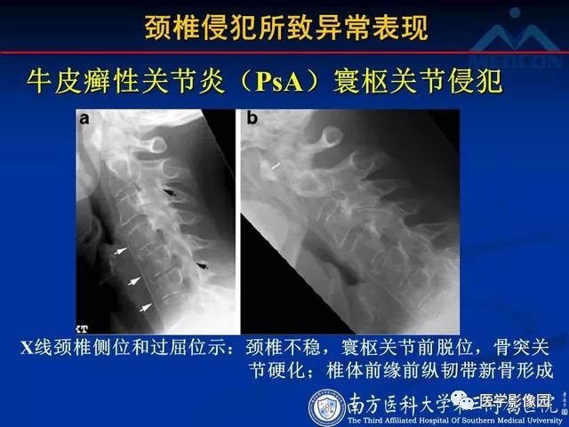 【PPT】系统性疾病脊椎侵犯病理学改变和影像学诊断