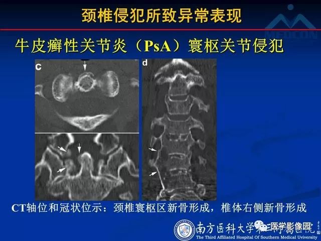 【PPT】系统性疾病脊椎侵犯病理学改变和影像学诊断