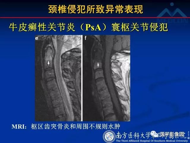 【PPT】系统性疾病脊椎侵犯病理学改变和影像学诊断