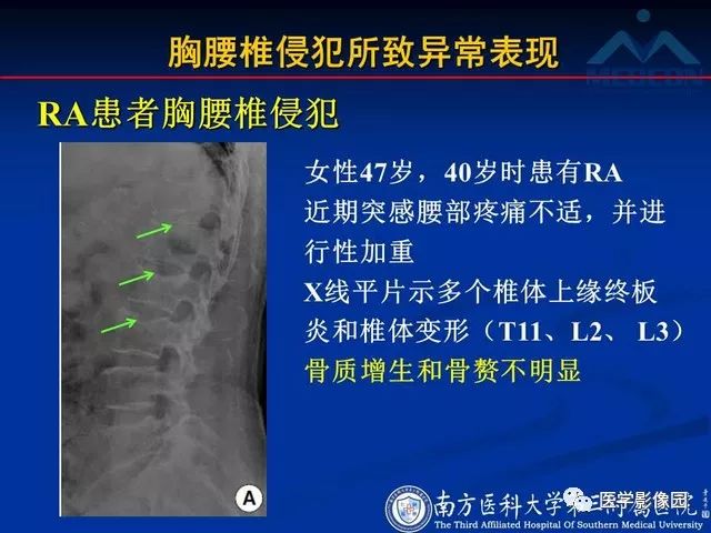 【PPT】系统性疾病脊椎侵犯病理学改变和影像学诊断