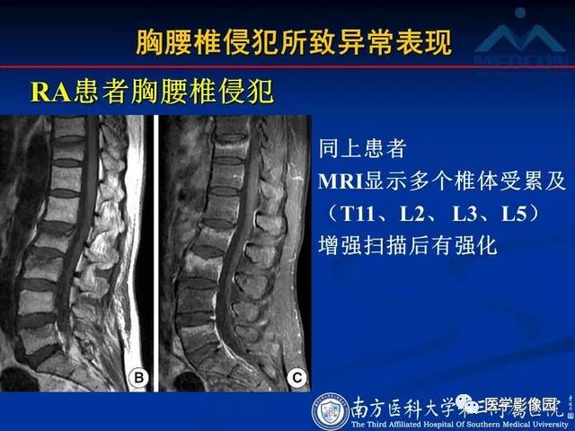 【PPT】系统性疾病脊椎侵犯病理学改变和影像学诊断
