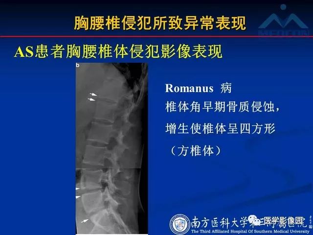 【PPT】系统性疾病脊椎侵犯病理学改变和影像学诊断