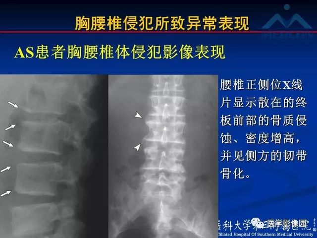 【PPT】系统性疾病脊椎侵犯病理学改变和影像学诊断