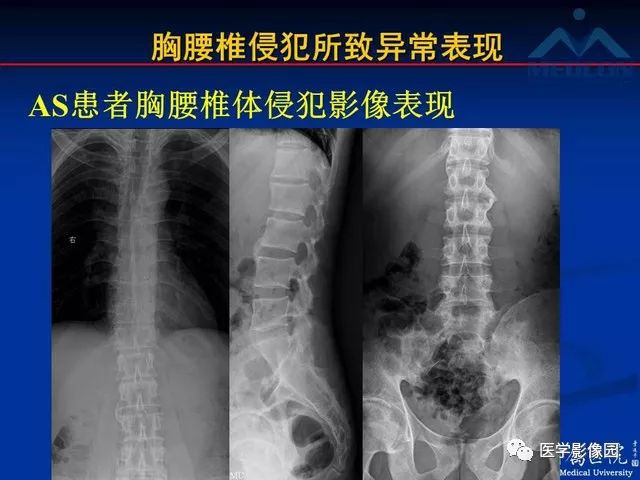 【PPT】系统性疾病脊椎侵犯病理学改变和影像学诊断