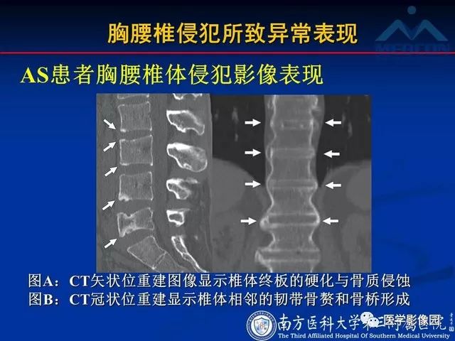 【PPT】系统性疾病脊椎侵犯病理学改变和影像学诊断
