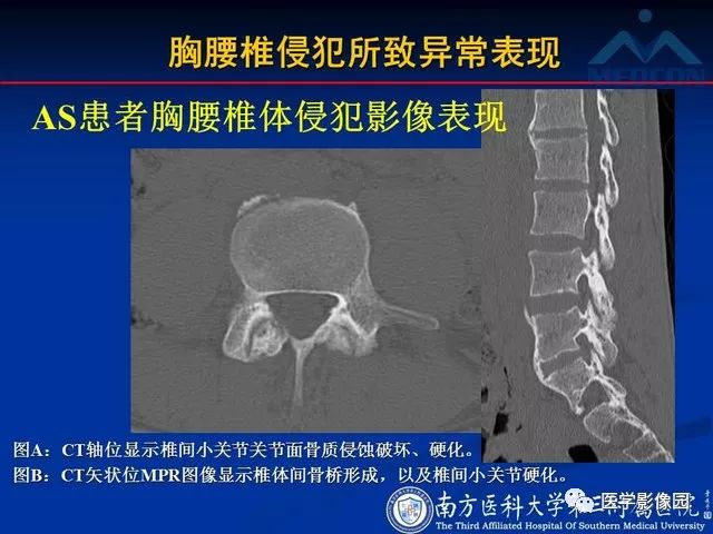 【PPT】系统性疾病脊椎侵犯病理学改变和影像学诊断