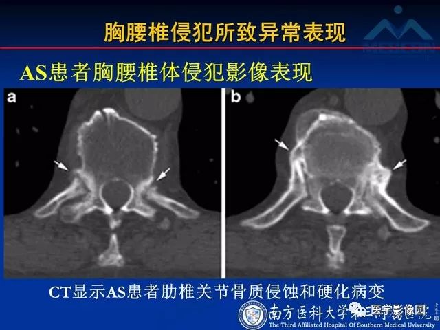 【PPT】系统性疾病脊椎侵犯病理学改变和影像学诊断
