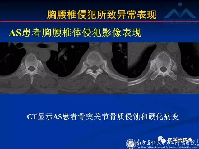 【PPT】系统性疾病脊椎侵犯病理学改变和影像学诊断
