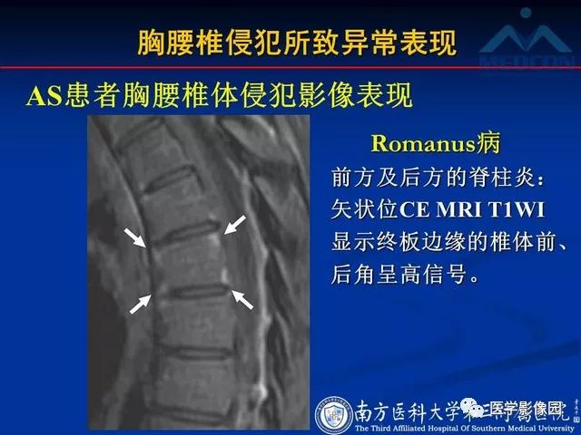 【PPT】系统性疾病脊椎侵犯病理学改变和影像学诊断