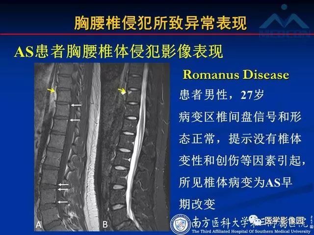 【PPT】系统性疾病脊椎侵犯病理学改变和影像学诊断
