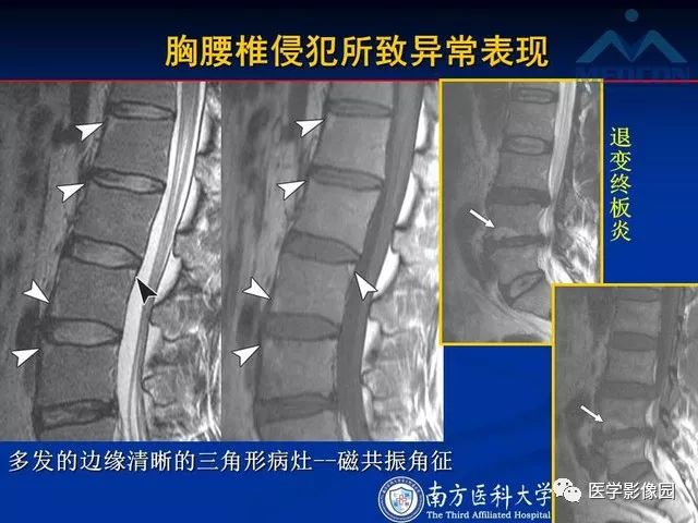 【PPT】系统性疾病脊椎侵犯病理学改变和影像学诊断