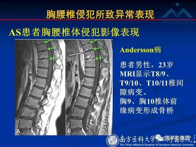 【PPT】系统性疾病脊椎侵犯病理学改变和影像学诊断