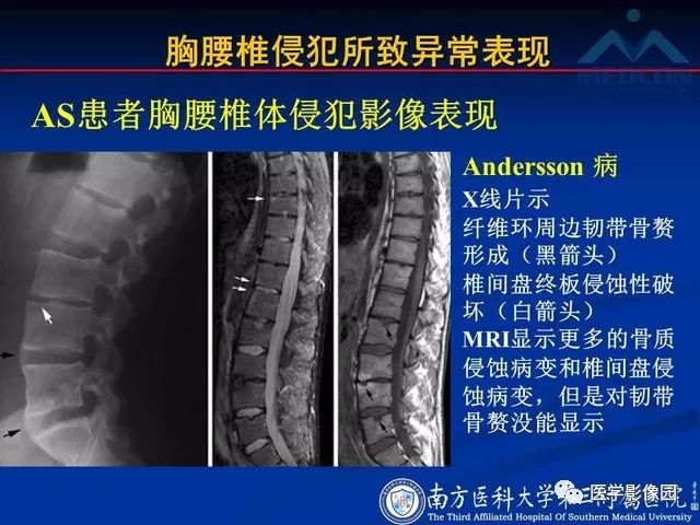 【PPT】系统性疾病脊椎侵犯病理学改变和影像学诊断