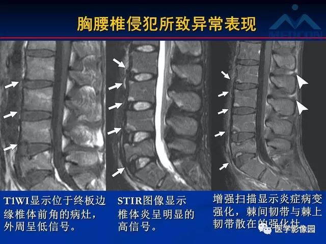 【PPT】系统性疾病脊椎侵犯病理学改变和影像学诊断