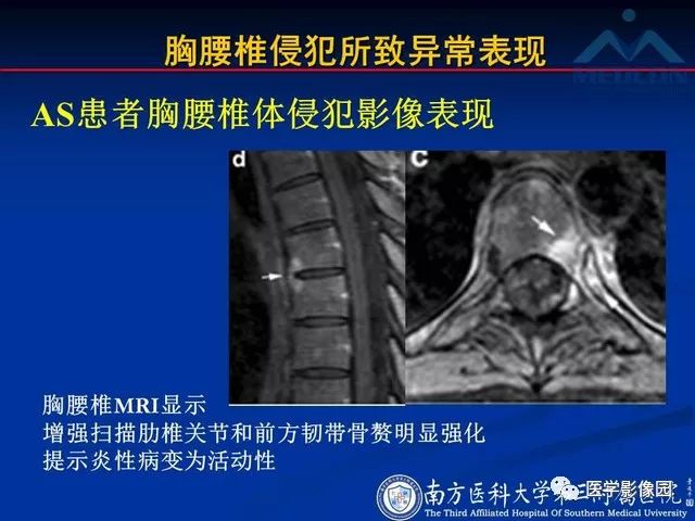 【PPT】系统性疾病脊椎侵犯病理学改变和影像学诊断