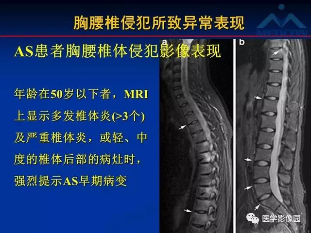 【PPT】系统性疾病脊椎侵犯病理学改变和影像学诊断
